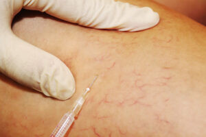 Efectos secundarios de la microespuma para varices a tener en cuenta​